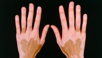 Vitiligo detoxikace – novinka