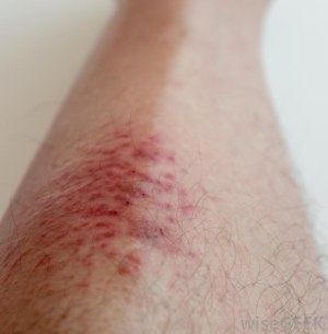 Alergická vyrážka na nohou