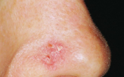 Rakovina kůže na nose