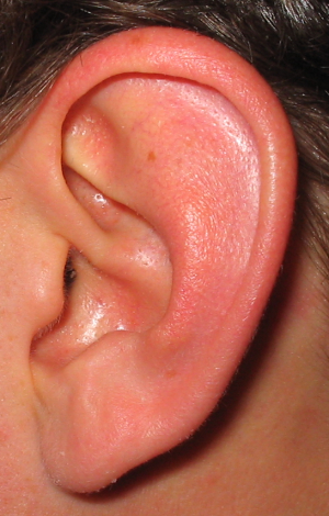 Zalehlé ucho
