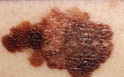 Melanom, zákeřná rakovina kůže