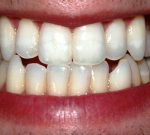 Zubní váček