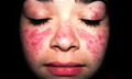 Příznaky nemoci lupus