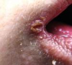 Anguli infektiosi – ústní koutky