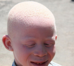 Albinismus